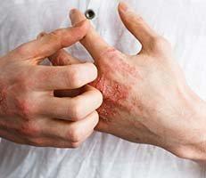 Eczema